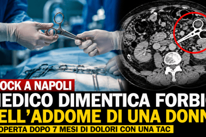 Sala operatoria e Tac con forbici chirurgiche dimenticate nell’addome di una donna dopo un intervento a Napoli
